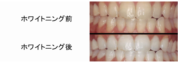 ホワイトニングの前後の比較